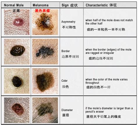 容易長痣|痣也可能会癌变！长在 3 个地方要注意